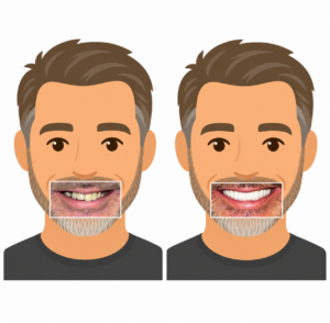 Kerry Voit DDS Dental Implants Before and After -Misaligned and Missing Teeth