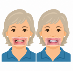 Kerry Voit DDS Dental Implants Before and After-Decaying and Missing Teeth