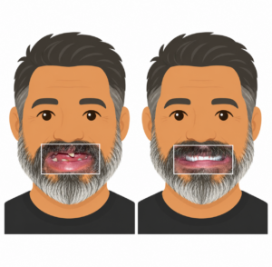 Kerry Voit DDS Dental Implants Before and After-Broken and Missing Teeth