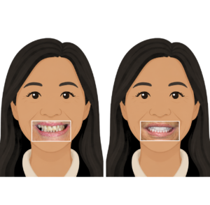 Kerry Voit DDS Dental Implants Before and After-Ill Fitting Partial-Crooked and Missing Teeth