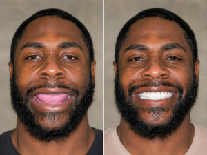 Kerry Voit DDS Dental Implants Before and After-Completely Missing Teeth