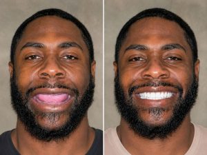 Kerry Voit DDS Dental Implants Before and After-Completely Missing Teeth